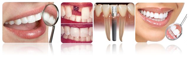 DentalImplants